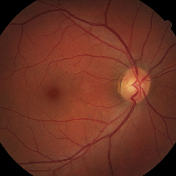 Muly_ID#19750_EYE-Right_abhao